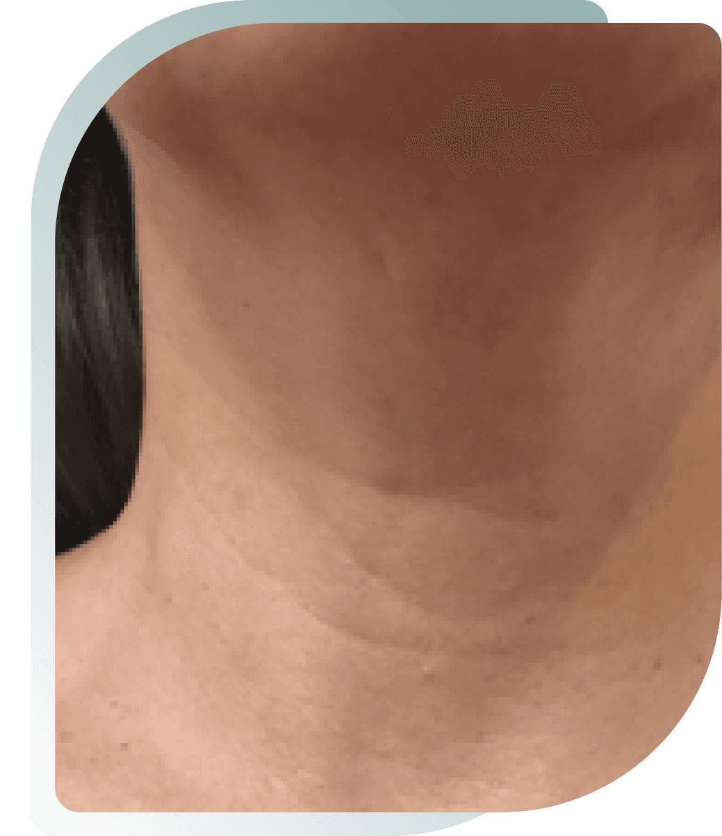 Neck Treatment — Before photo (result 4 of 5)