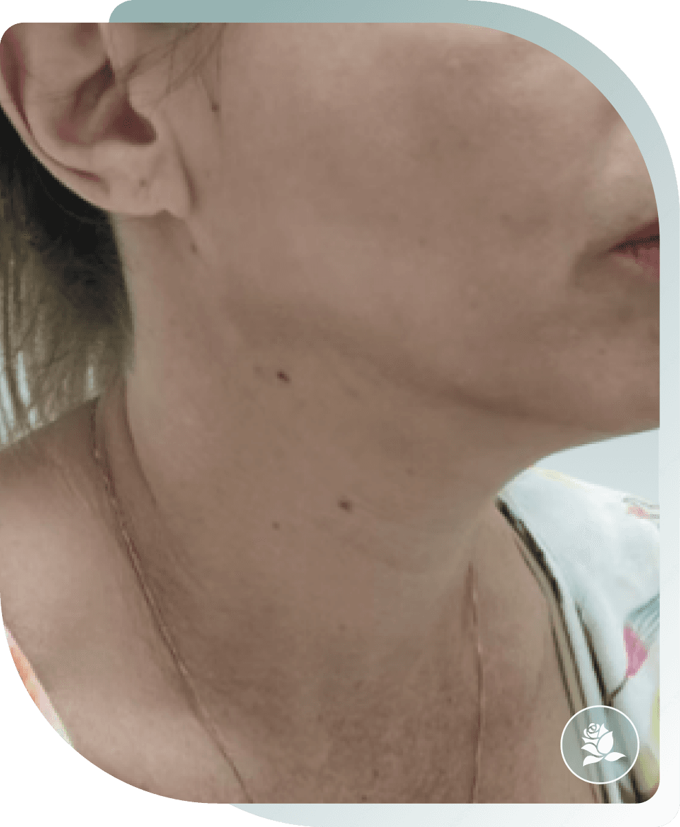 Jawline & Neck — After photo (result 5 of 5)