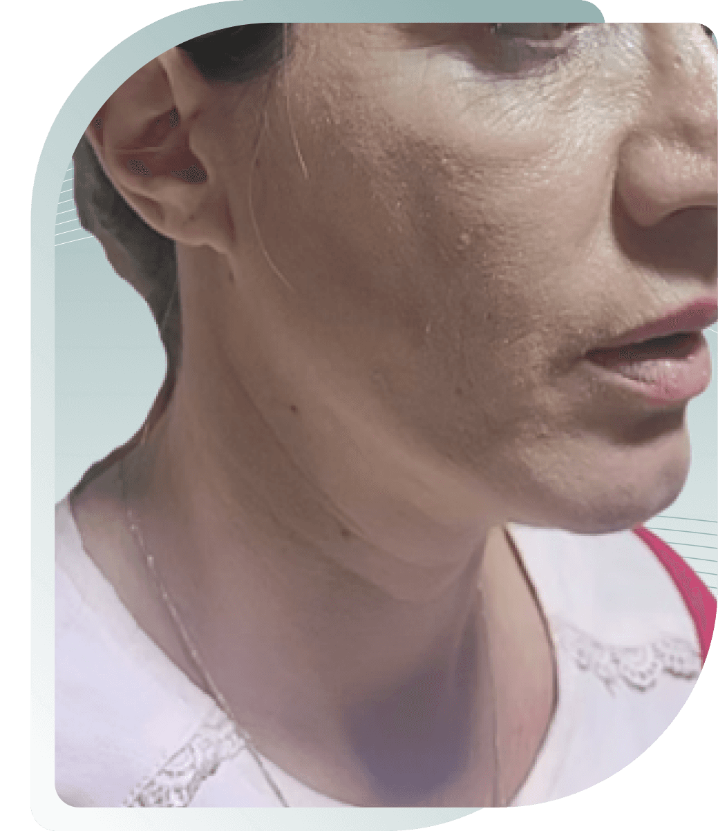 Jawline & Neck — Before photo (result 5 of 5)