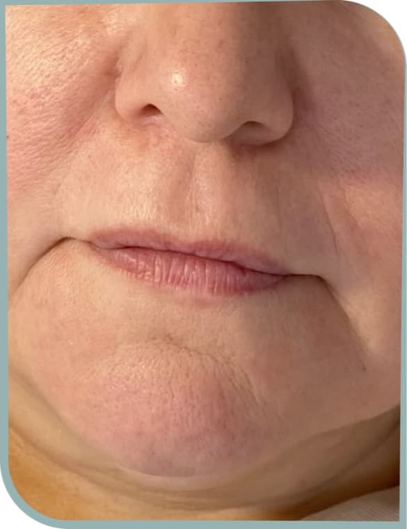 Perioral lines, Before photo (result 7 of 10)