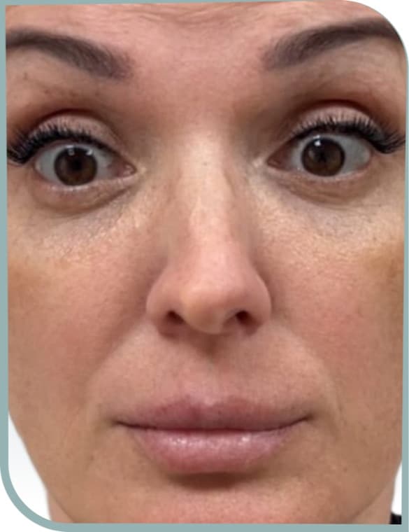 Under eye area, Before photo (result 9 of 10)