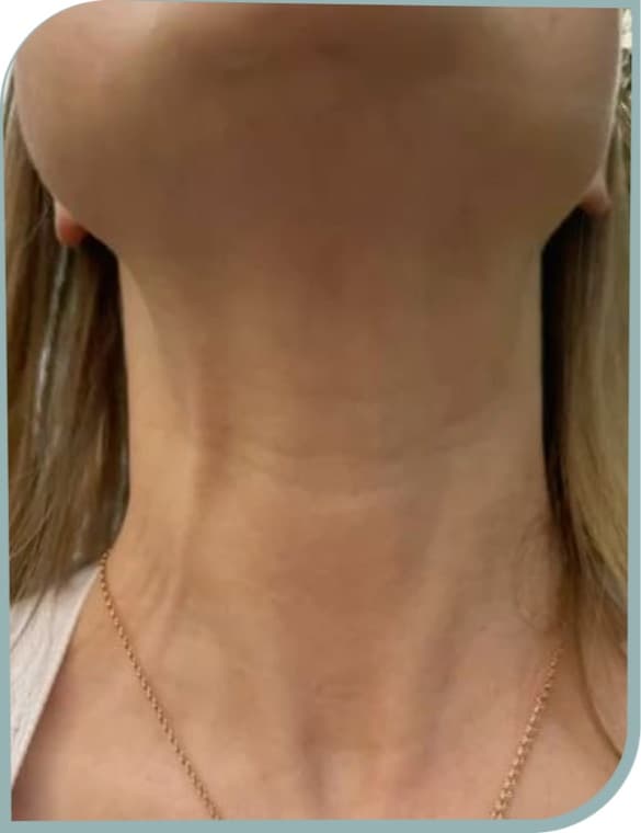 Neck bands, After photo (result 8 of 10)