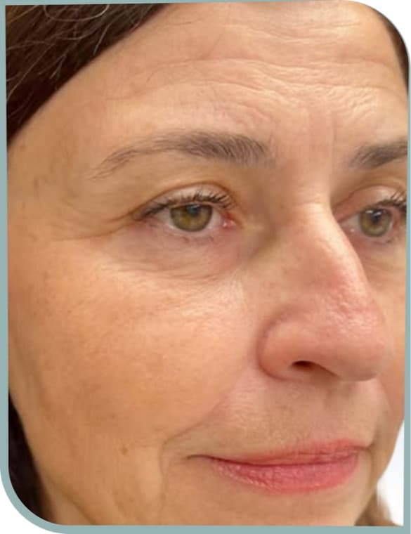 Fine lines around eyes, Before photo (result 1 of 10)