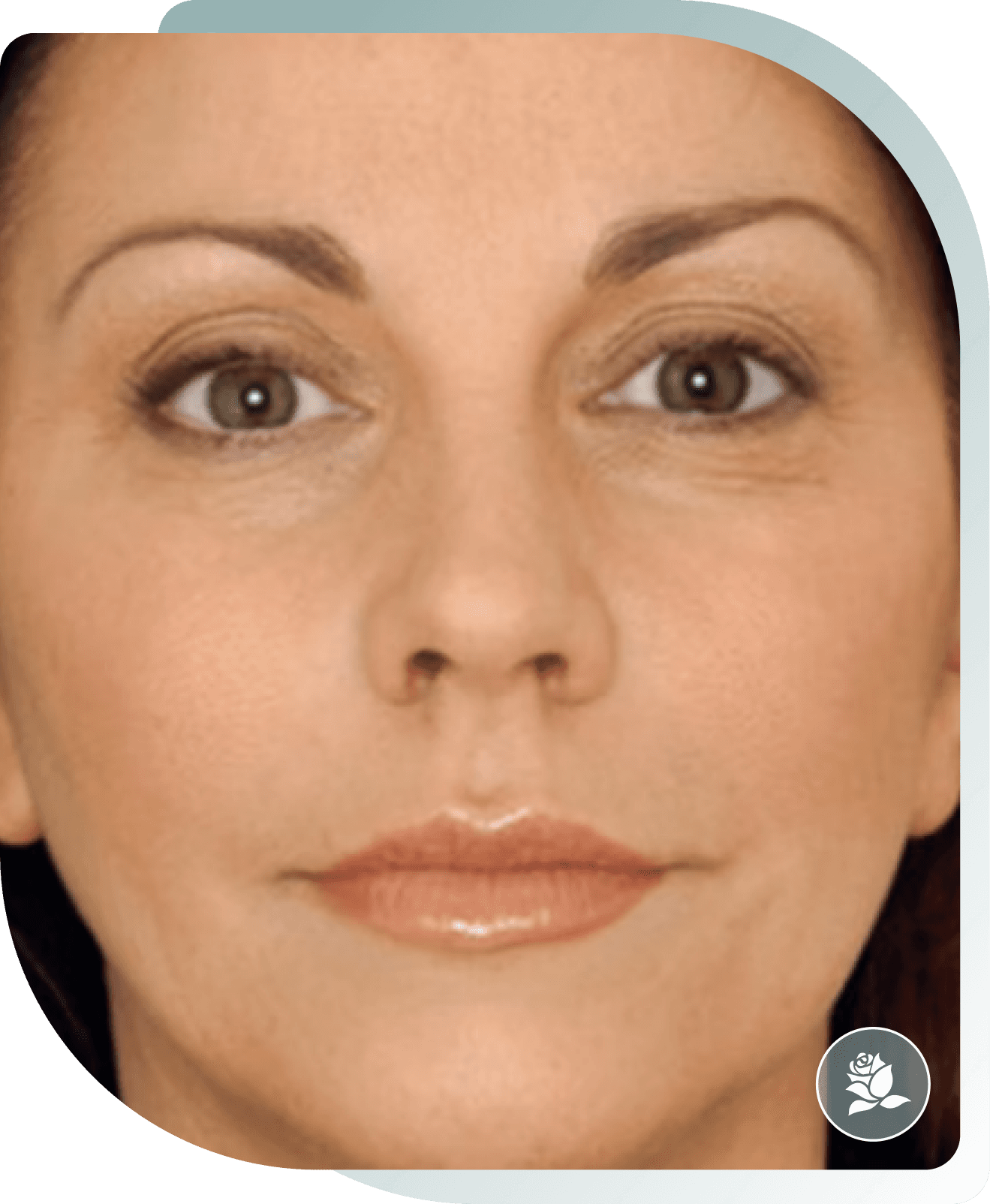 Face Rejuvenation — After photo (result 1 of 5)