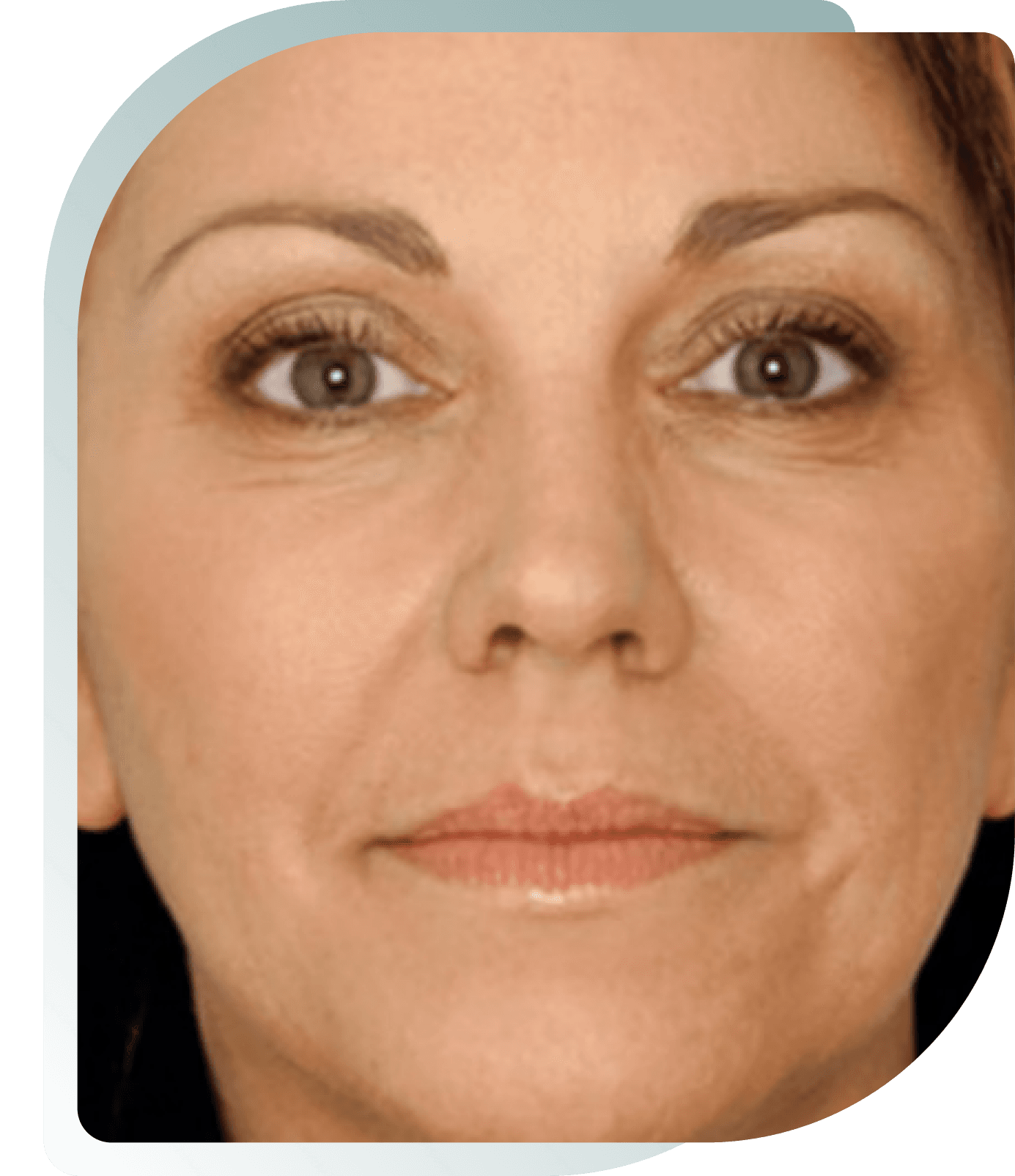Face Rejuvenation — Before photo (result 1 of 5)