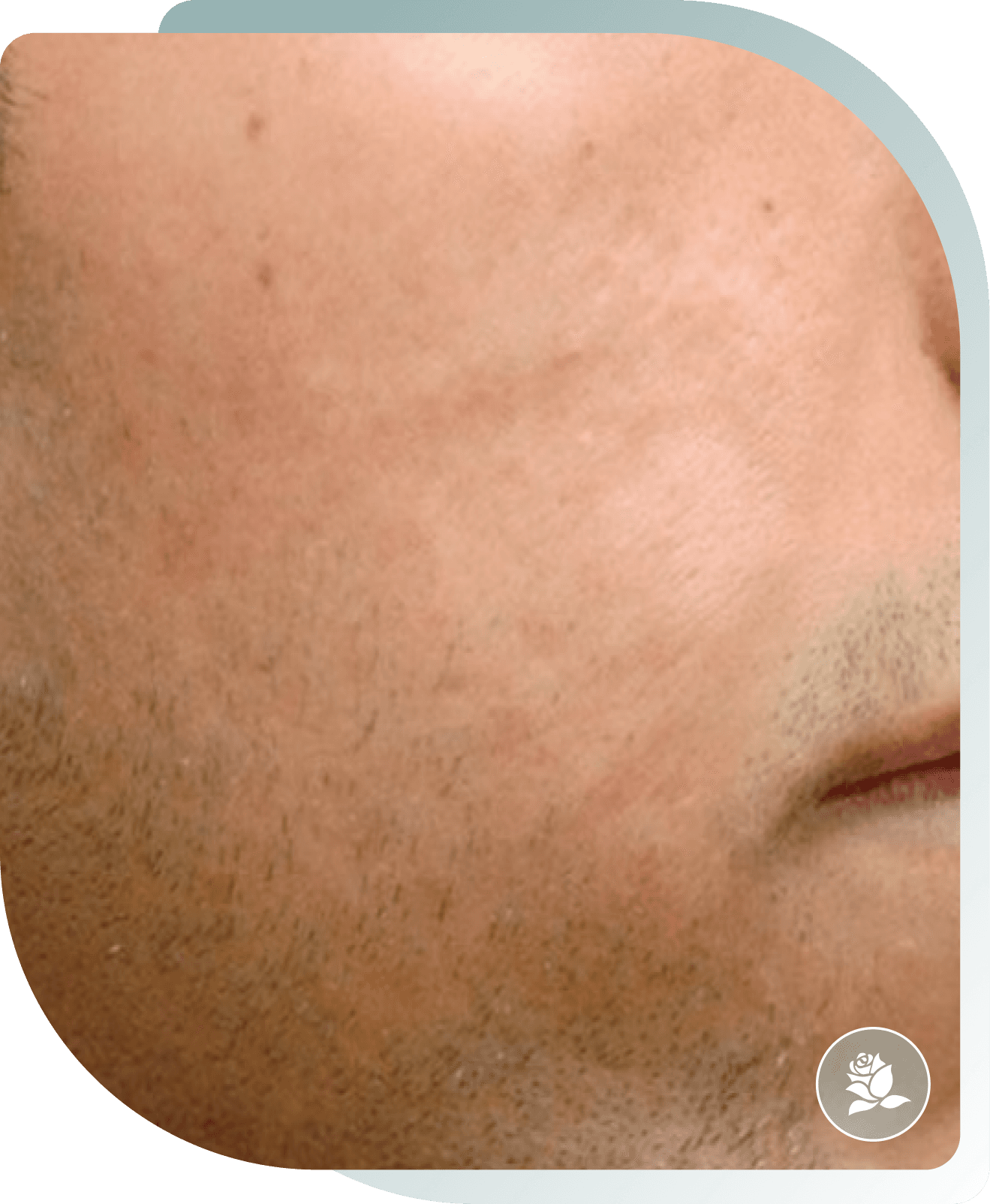 Acne Scarring — After photo (result 2 of 5)