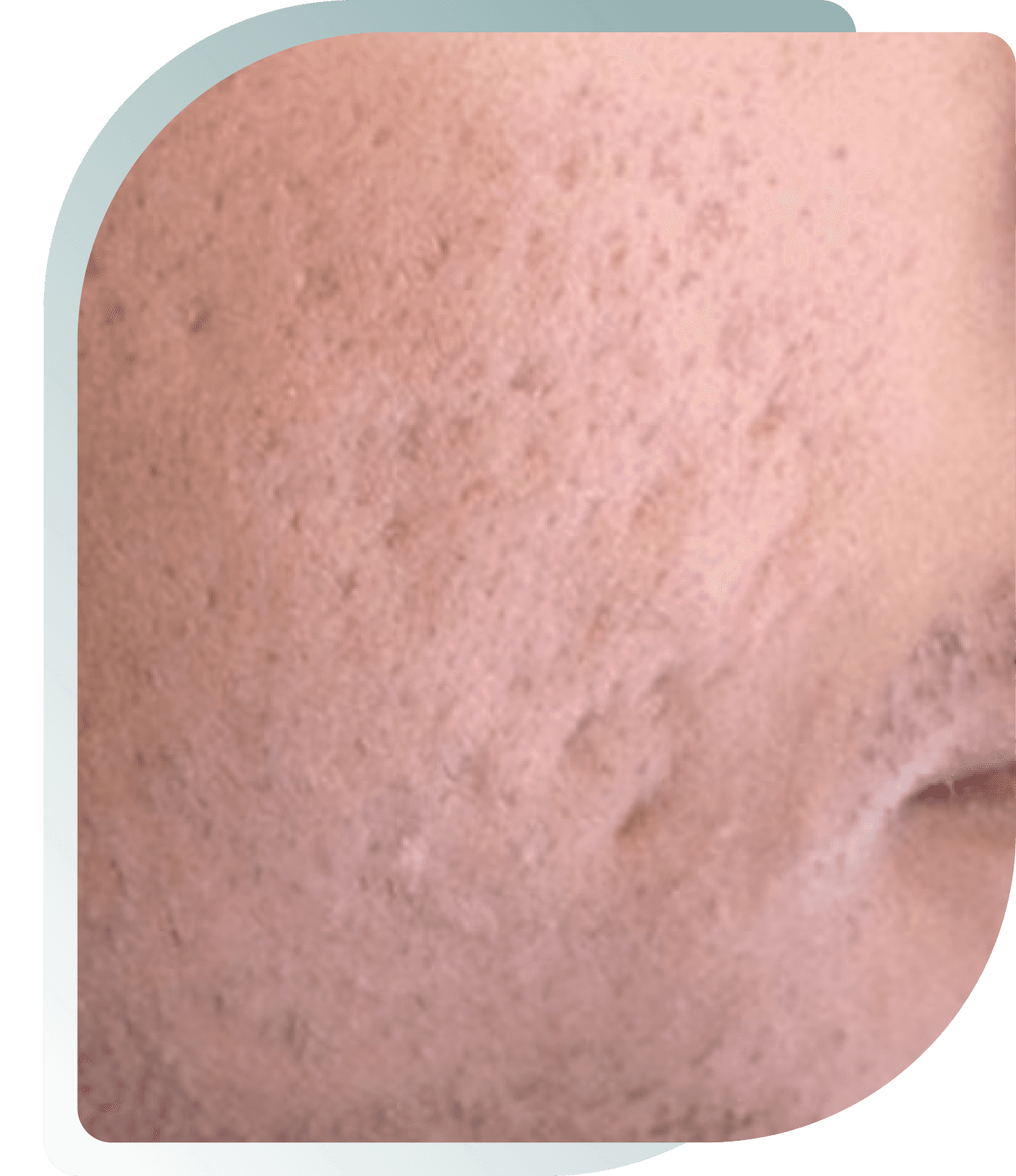 Acne Scarring — Before photo (result 2 of 5)