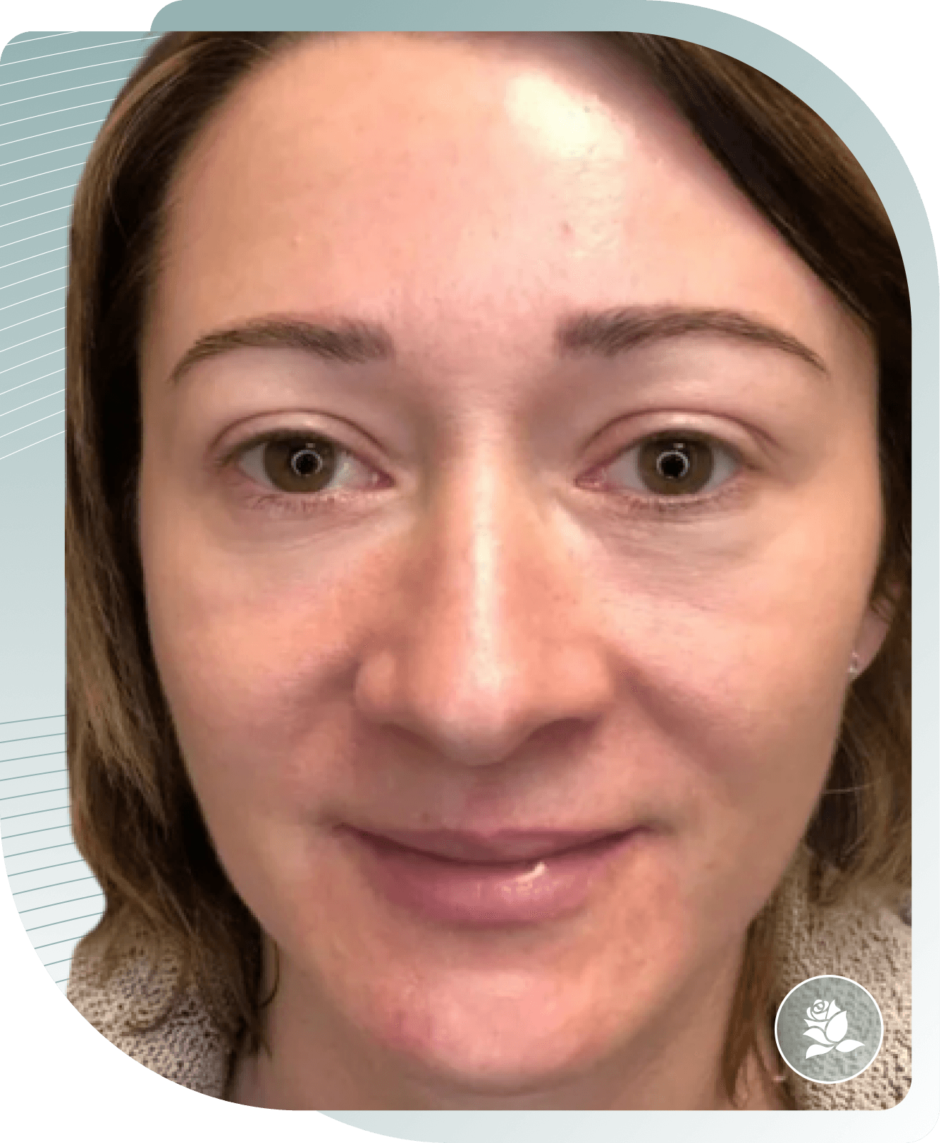 Skin Quality — After photo (result 3 of 5)