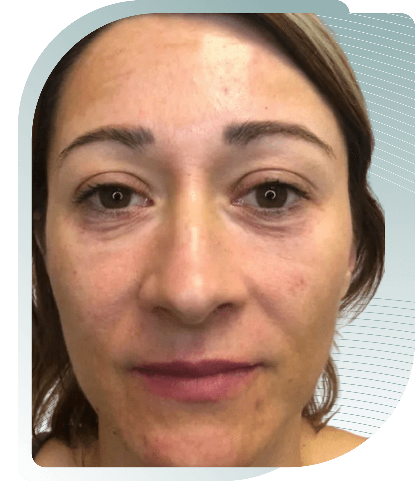 Skin Quality — Before photo (result 3 of 5)