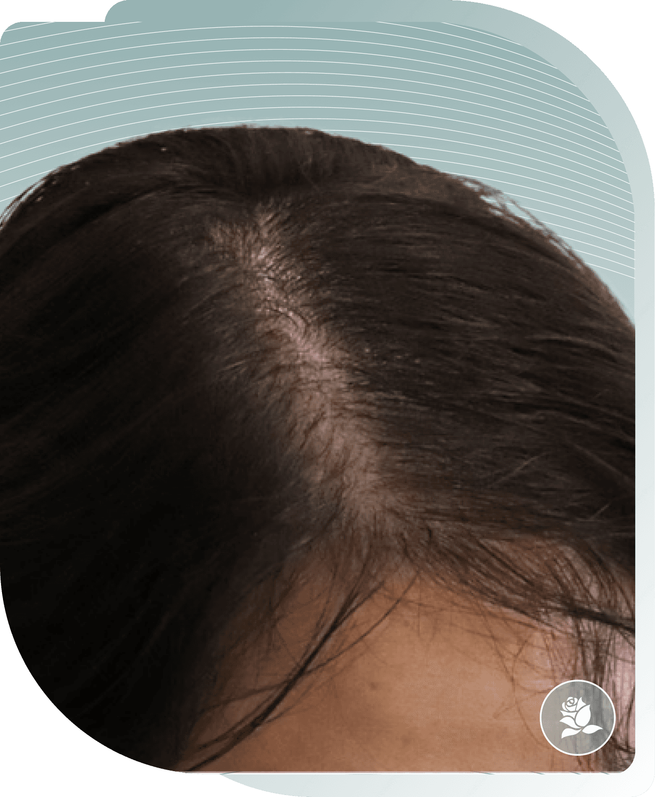 Hair Loss (Female) — After photo (result 4 of 5)