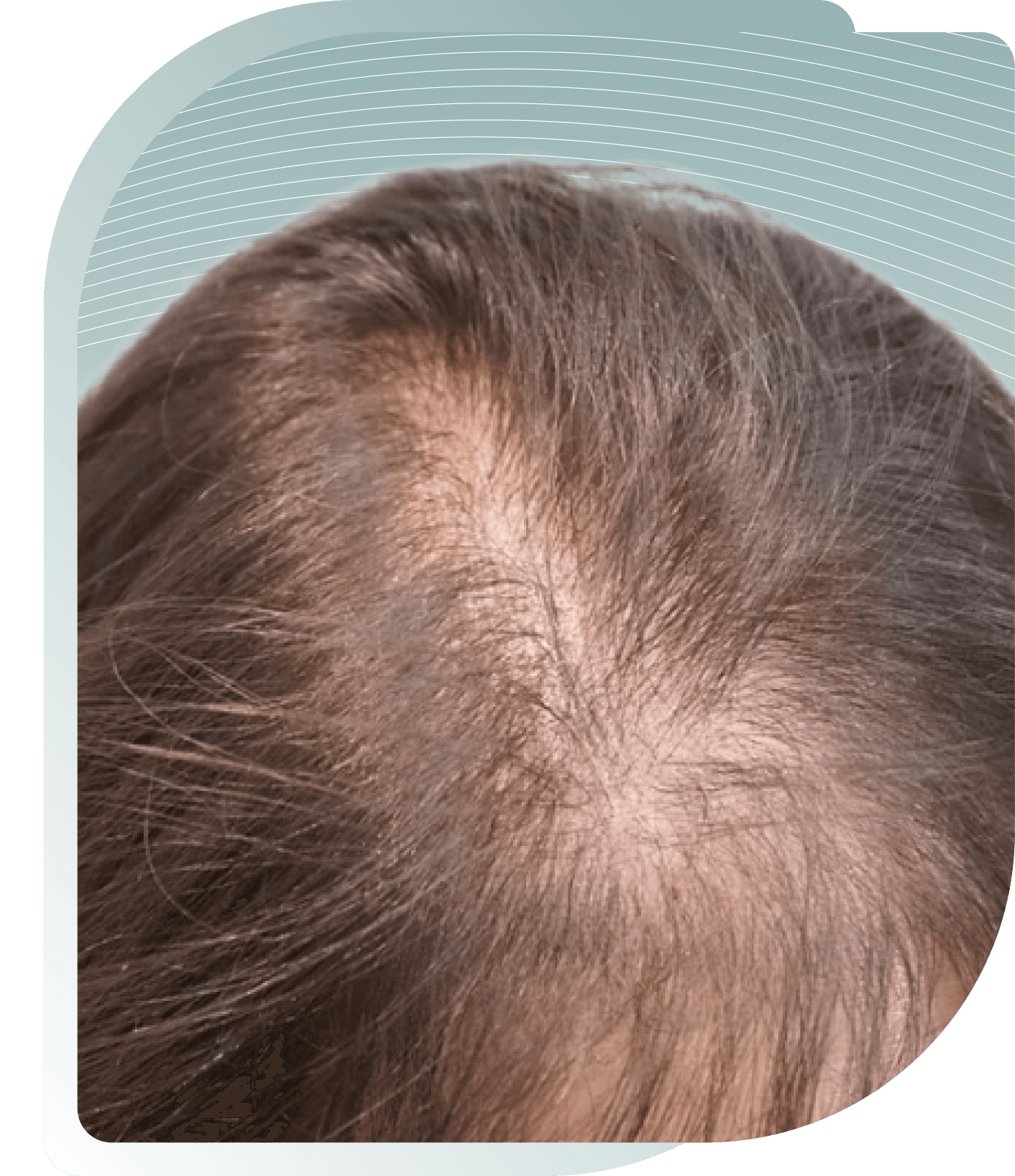 Hair Loss (Female) — Before photo (result 4 of 5)