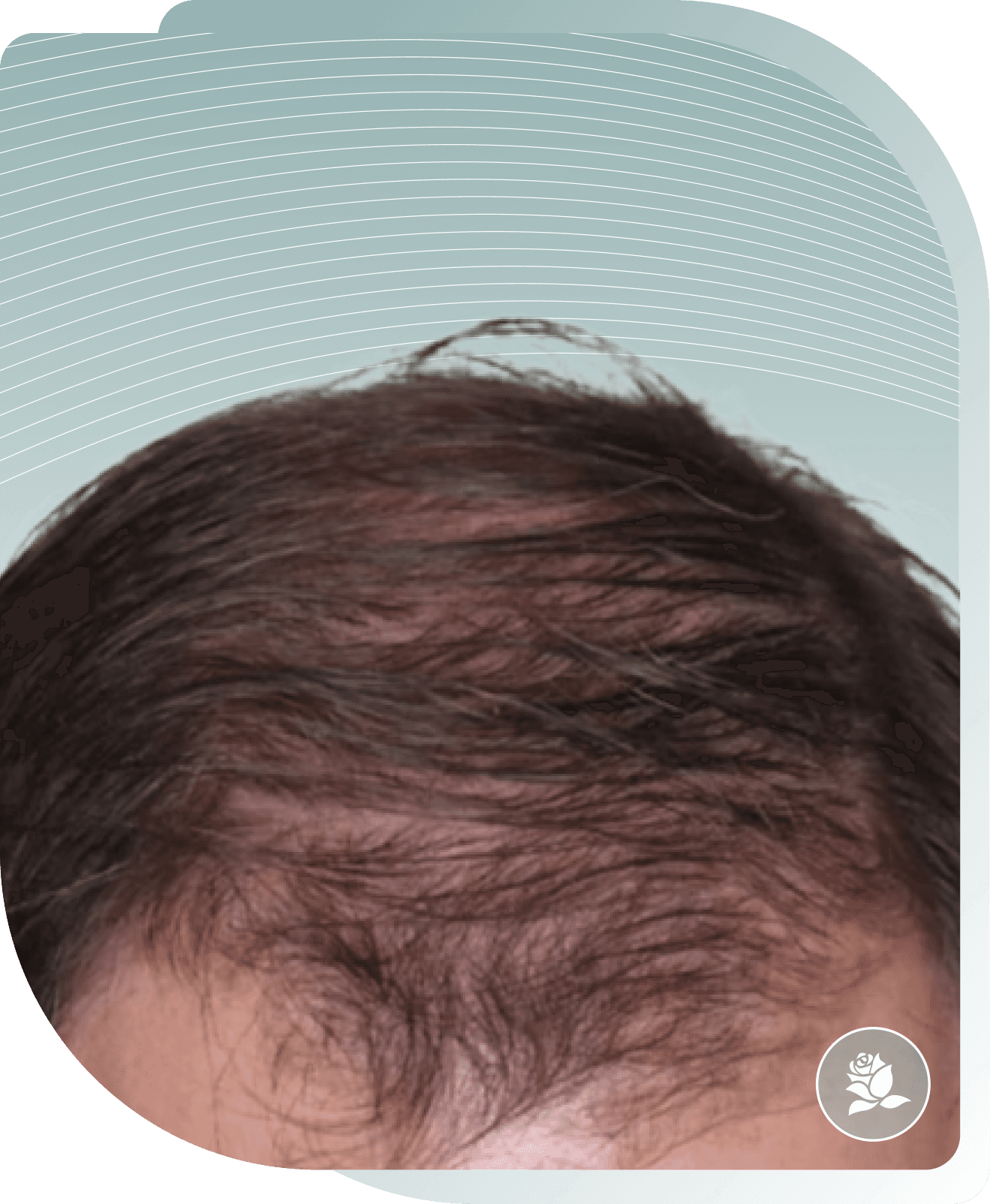 Hair Loss (Male) — After photo (result 5 of 5)