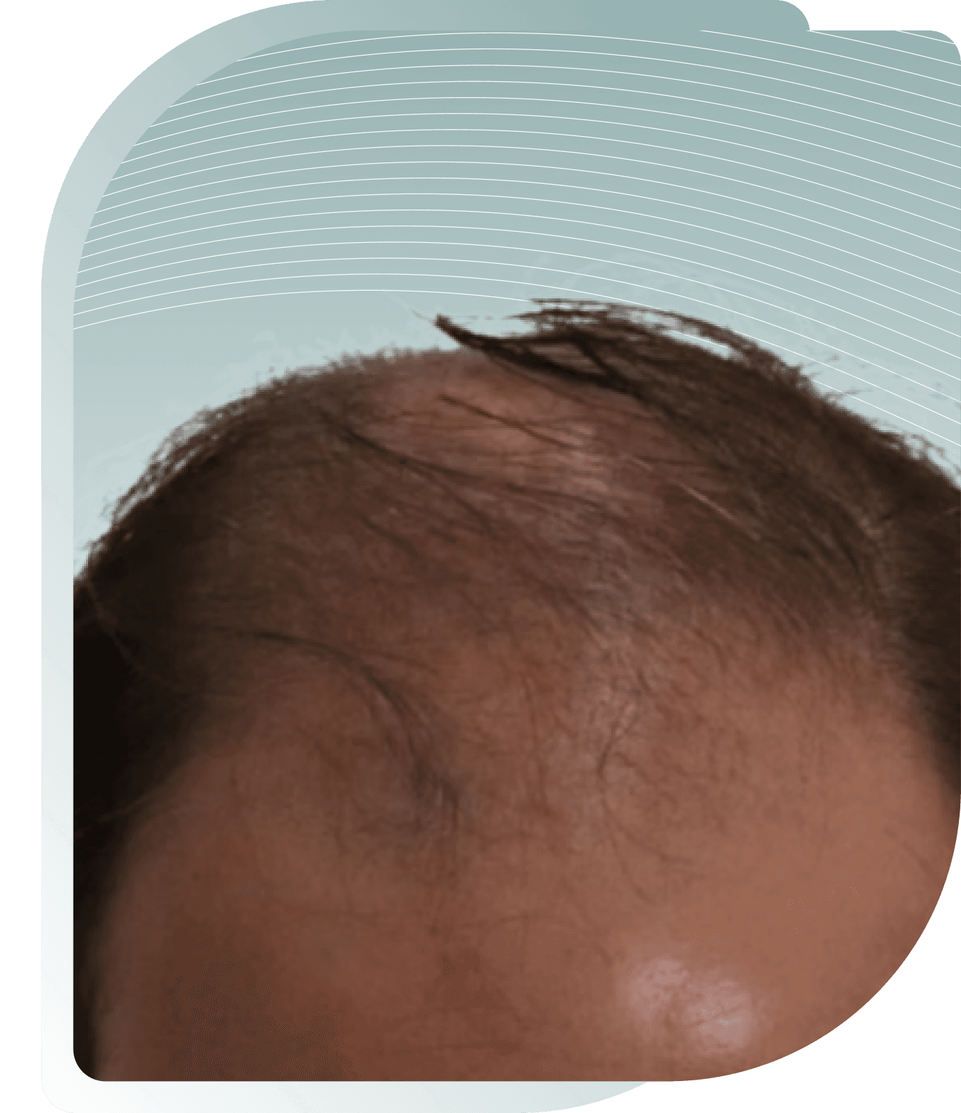 Hair Loss (Male) — Before photo (result 5 of 5)