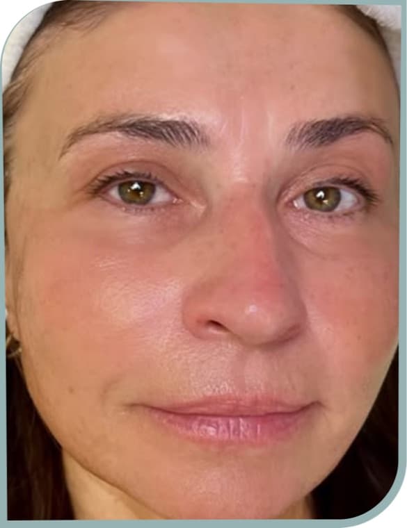 Fine lines around eyes, After photo (result 1 of 10)