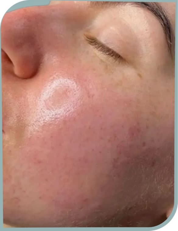 Pigmentation on cheek, After photo (result 2 of 10)