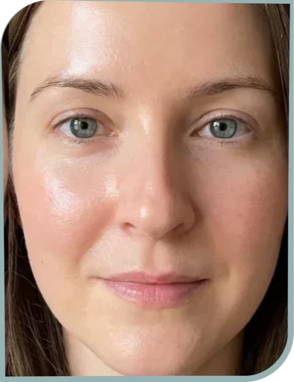 Dull tired skin, After photo (result 5 of 10)
