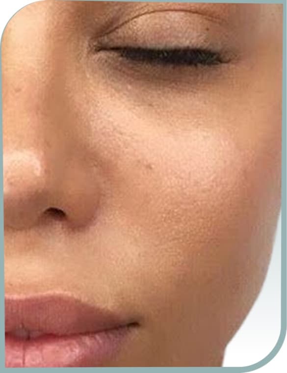 Cheek pigmentation, After photo (result 6 of 10)