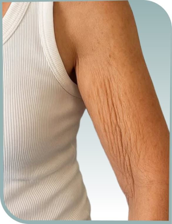 Upper arm laxity, Before photo (result 1 of 10)