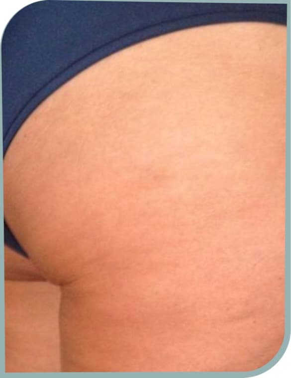 Outer thigh cellulite, After photo (result 9 of 10)
