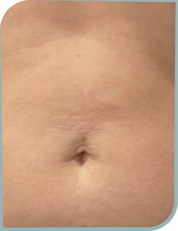 Navel skin laxity, After photo (result 10 of 10)