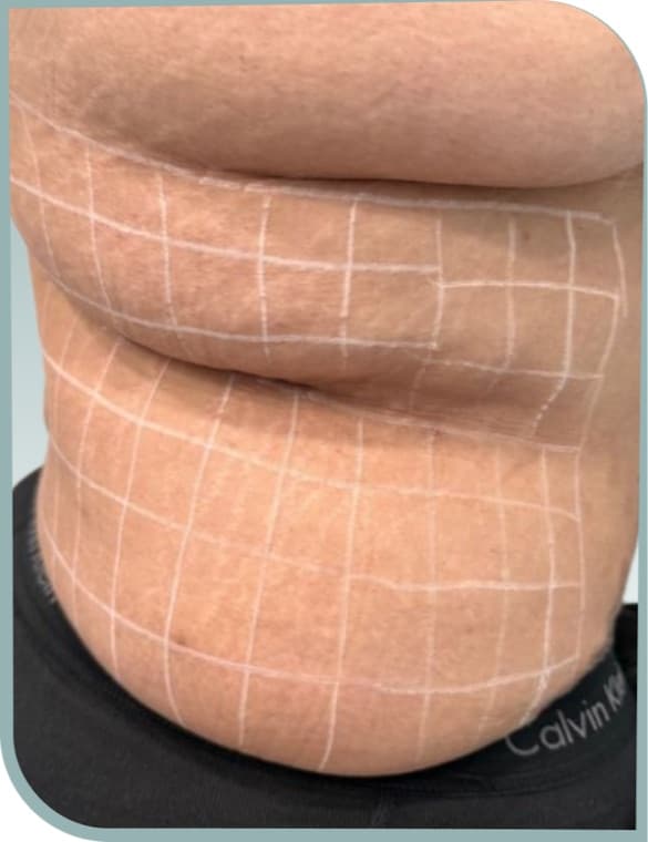 Flank skin folds, Before photo (result 4 of 10)