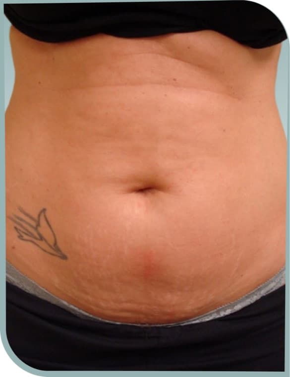 Lower belly laxity, Before photo (result 5 of 10)