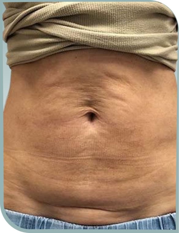 Stomach crepiness, Before photo (result 6 of 10)