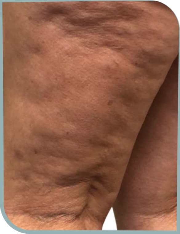 Thigh cellulite, Before photo (result 8 of 10)