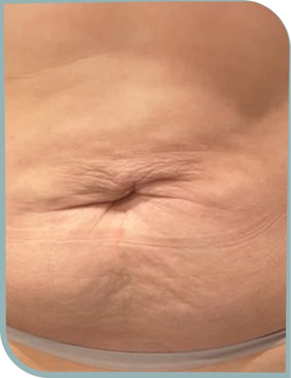 Navel skin laxity, Before photo (result 10 of 10)