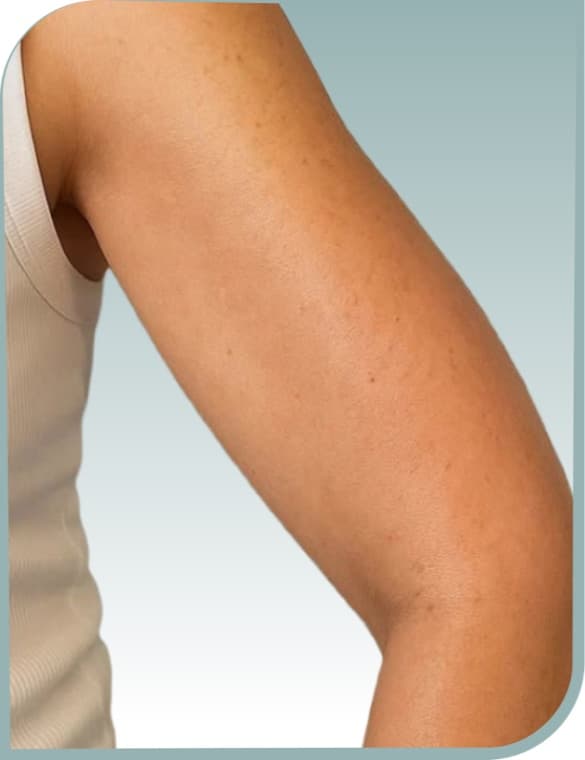 Upper arm laxity, After photo (result 1 of 10)