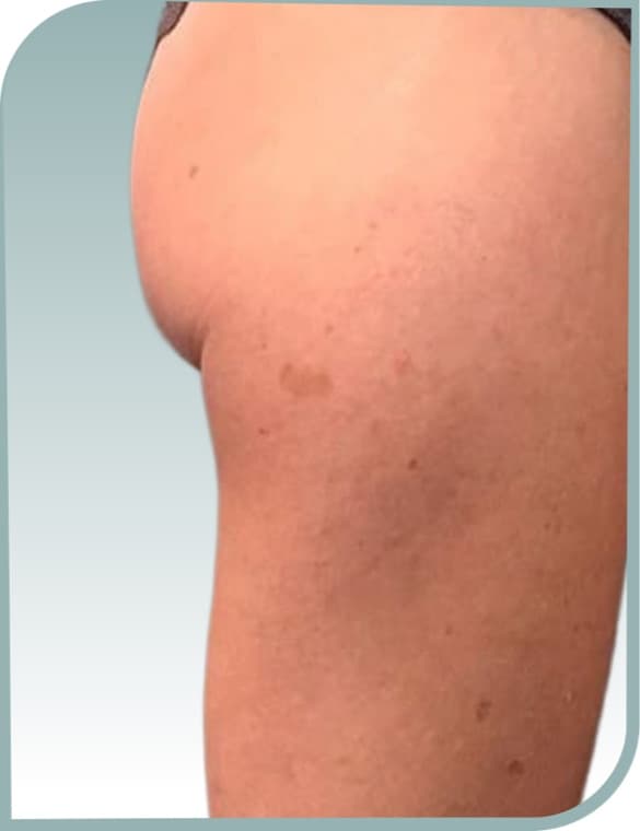 Thigh dimpling, After photo (result 2 of 10)