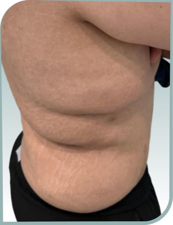 Flank skin folds, After photo (result 4 of 10)