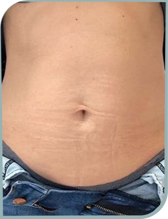 Stomach crepiness, After photo (result 6 of 10)