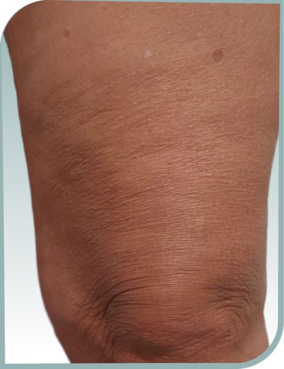Above-knee crepiness, After photo (result 7 of 10)