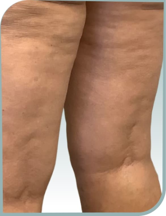 Thigh cellulite, After photo (result 8 of 10)