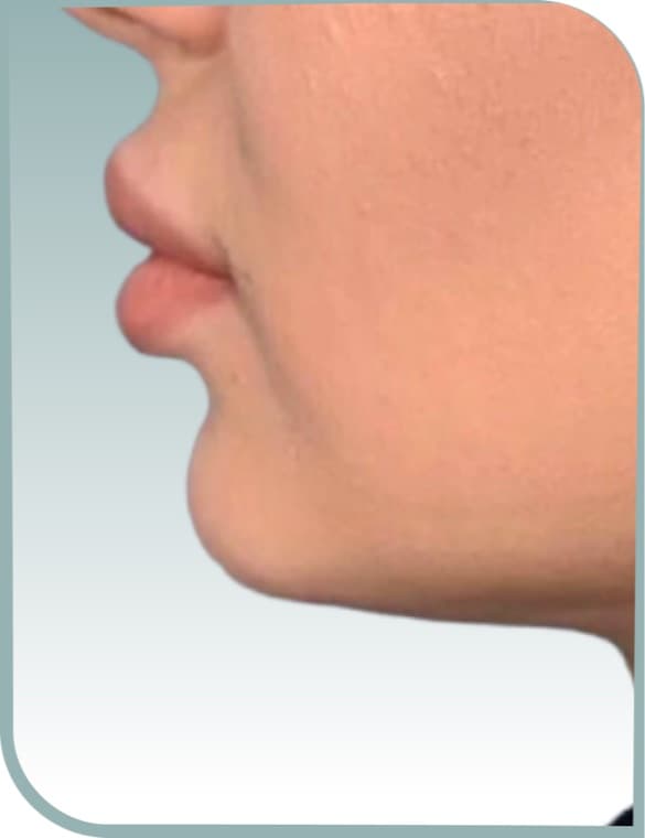 Chin projection, Before photo (result 2 of 10)