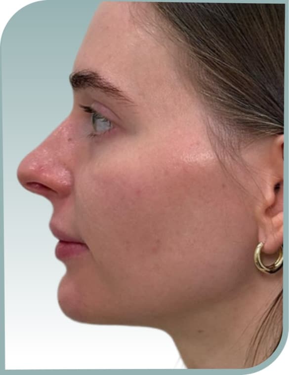 Jaw and chin shaping, After photo (result 5 of 6)