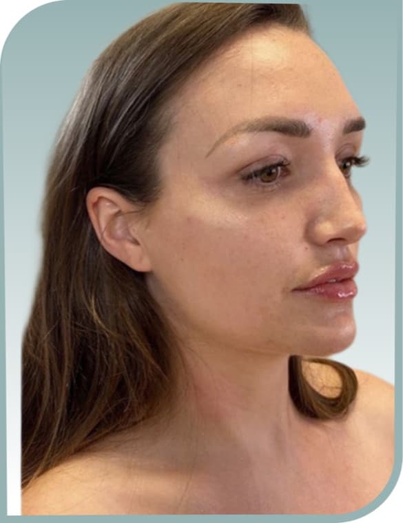 Jawline shaping, After photo (result 10 of 10)