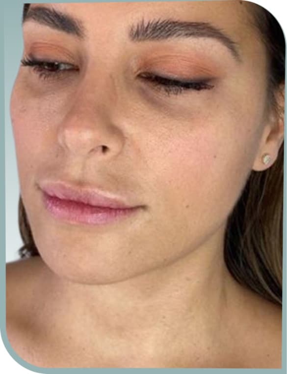 Lower face contour, Before photo