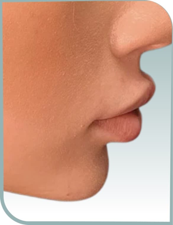 Chin and lip balance, Before photo