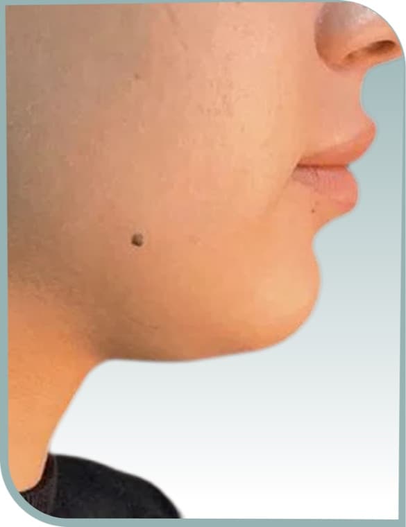 Jaw and neck contour, Before photo (result 1 of 6)