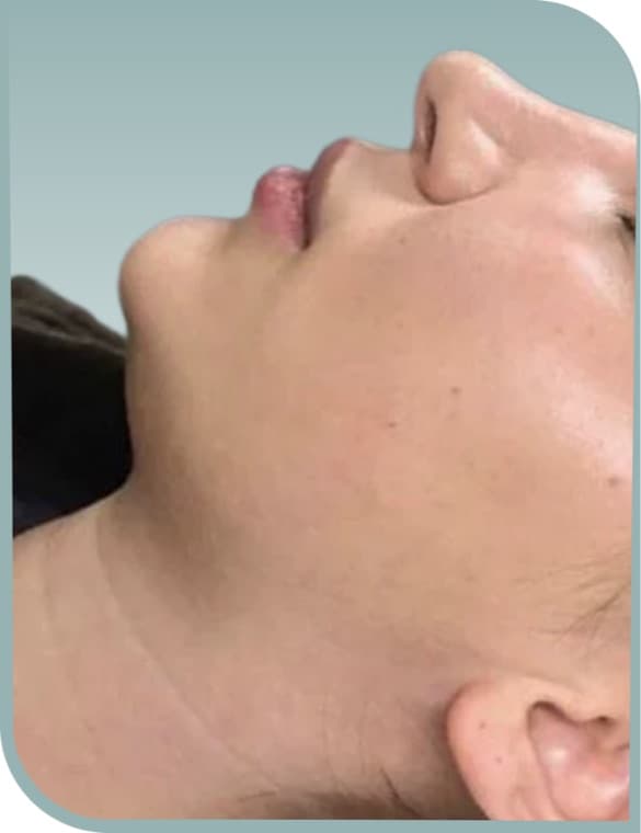 Submental contour, Before photo (result 2 of 6)