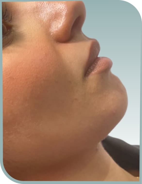 Jawline definition, Before photo (result 3 of 6)