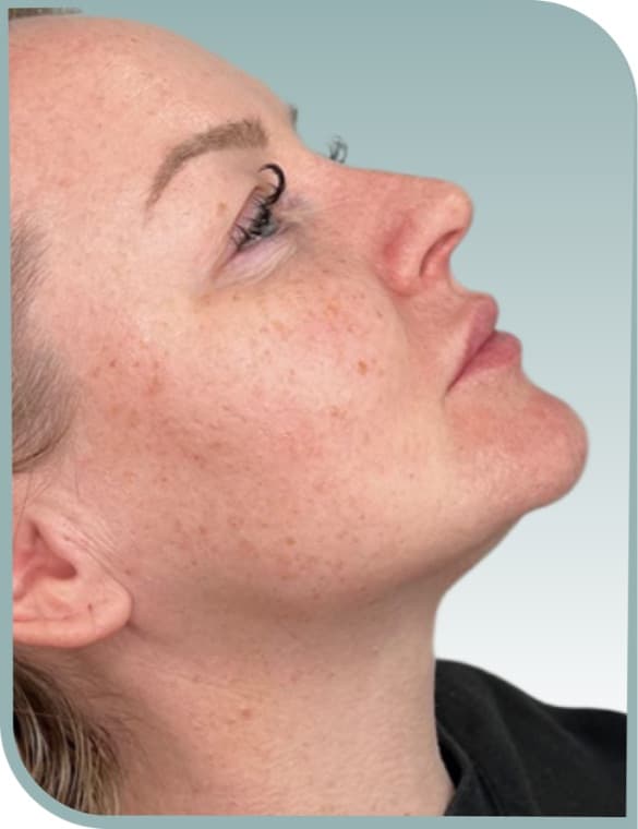 Jawline definition, Before photo (result 4 of 6)