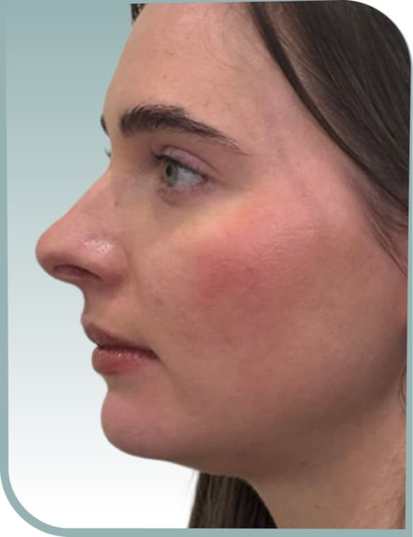 Jaw and chin shaping, Before photo (result 5 of 6)