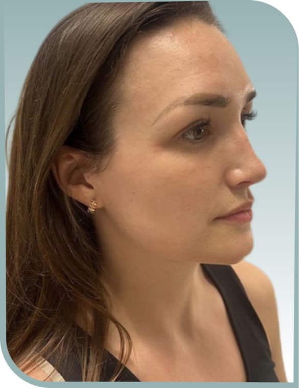 Jawline shaping, Before photo (result 6 of 6)