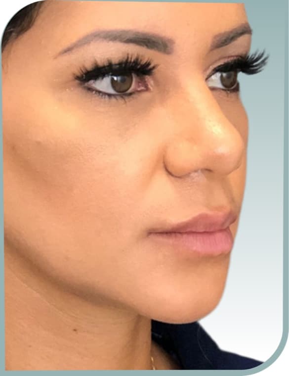 Jawline definition, After photo (result 1 of 10)