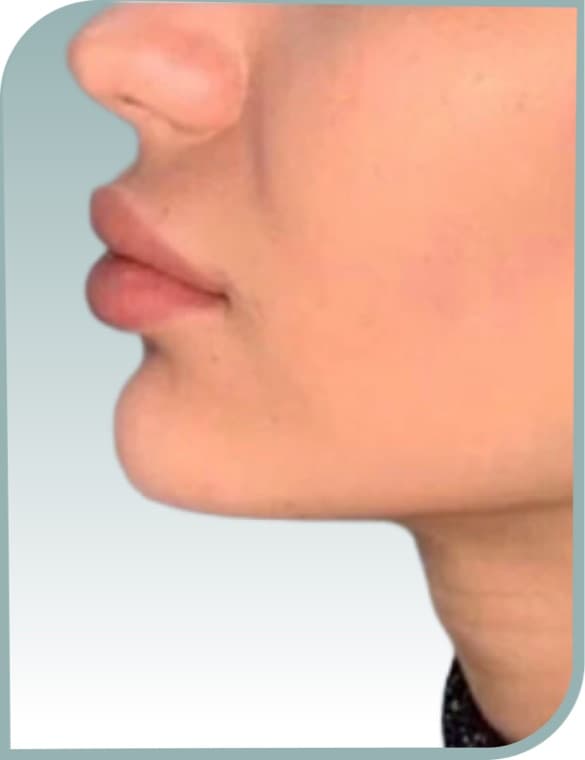 Chin projection, After photo (result 2 of 10)