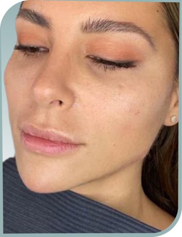 Lower face contour, After photo