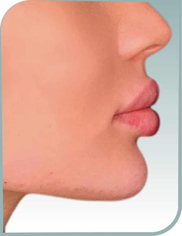 Chin and lip balance, After photo (result 4 of 10)